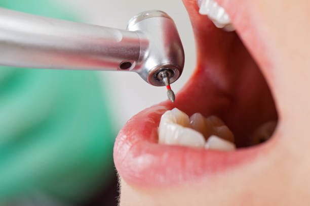 Best Emergency Root Canal Treatment in Secy, AR